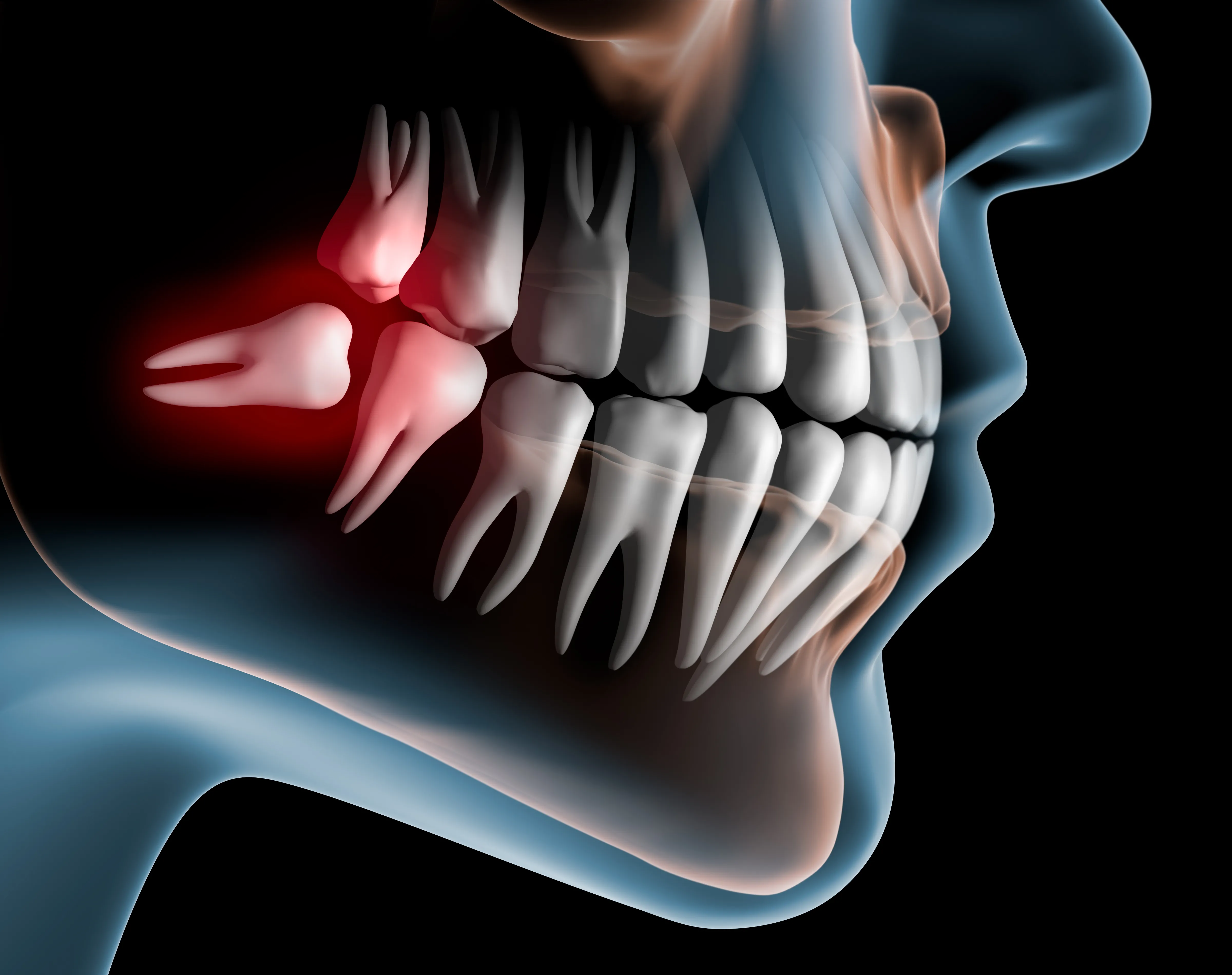 3D X-ray illustration of a human jaw showing impacted lower wisdom teeth highlighted in red